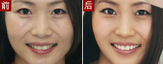 牙齿美白