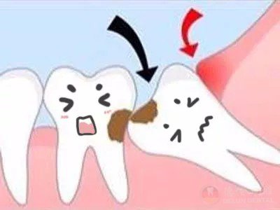 急急护牙丨智齿出现这6种情况,一定要拔!否则